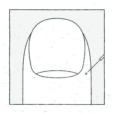 004 BLOODLETTING 刺絡